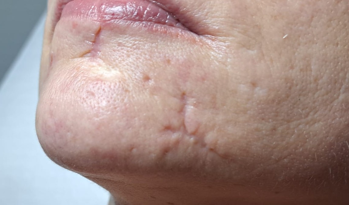 Narbenbehandlung bei Laser Ästhetik Holzkirchen